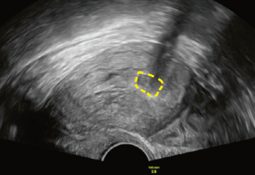 Abb. 5. Postinterventionelles Bild des Uterus mit dem thrombosierten Aneurysma.