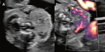 Abb. 2. (A) Querschnitt durch den fetalen Hals mit Vergrösserung der untersuchten Region; (B) Darstellung mit gepulstem Doppler. Atypische Durchblutungsmuster.