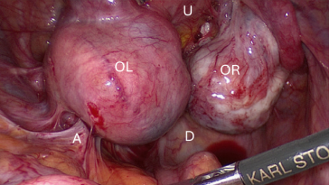 Abb. 1. Tief infiltrierende Endometriose mit Verwachsungen zwischen beiden Ovarien (Kissing Ovaries: OR = Ovar rechts, OL = Ovar links), Verwachsungen zwischen Ovar links und Beckenwand (A); Uterus (U) und Darm (D).