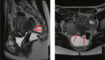 Abb. 2. MRI mit Nachweis einer Adenomyose (‡) und einer Darmendometriose (rote Pfeile)