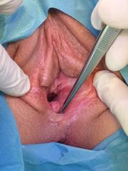 Abb. 3. Frenulum Vestibuli