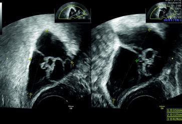 Abb. 1. Sonographisches Bild mit multizystischem Befund. Es erfolgte die komplette Resektion des Befundes per Laparo-skopie. Die im Douglas gelegene Raumforderung imponierte klinisch als Peritonealzyste und wurde im Bergebeutel in toto geborgen und zur histopathologischen Befundung übersandt.