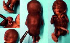 Auflösung Sonoquiz: Arthrogryposis multiplex congentia (AMC) bei Escobar Syndrom