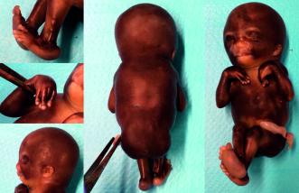 Bilder. Postpartale Bilder des Kindes mit diesen multiplen Kontrakturen der Gelenke, Fuss- und Hand/Finger-Fehlstellungen und den bereits pränatal nachgewiesenen Kopfauffälligkeiten