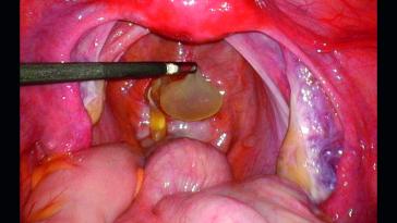 Abb. 2. Intraoperativer Situs.