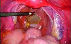 Im Bild: Benignes multizystisches Mesotheliom bei einer jungen Frau