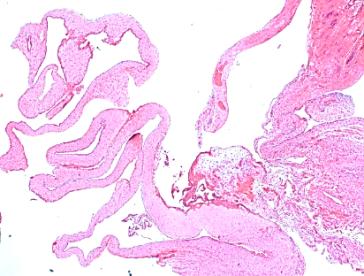 Abb. 3. HE Färbung (A) und immunhistochemischer Nachweis von Calretinin in der mesothelialen Auskleidung der Zyste (B)