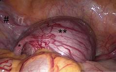 Im Bild: Extrauteringravidität in rudimentärem Uterushorn (4Ua)