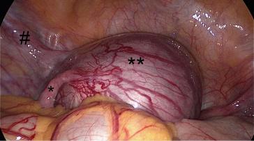 Abb. 1. Extrauterine Schwangerschaft im rudimentären linken Uterus Horn (**) bei einer ESHRE/ESGE-U4a-Malformation (# Ligamentum Rotundum links; * linke Tube).