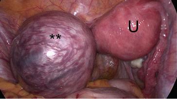 Abb. 2. Extrauterine Schwangerschaft im rudimentären linken Uterus Horn (**) bei einer ESHRE/ESGE-U4a-Malformation (U: normaler rechter Hemi-Uterus).