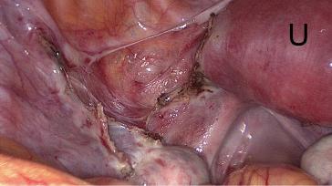 Abb. 3. Status nach Resektion des linken Uterus Horn (U: normaler rechter Hemi-Uterus).