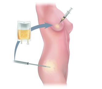 Abb 1. Phasen des Lipofillings (Fettgewinnung, Sedimentation, Einbringung am Zielort) Quelle: https://tprsg.com/restorative-techniques/related-breast-surgery-procedures/fat-grafting
