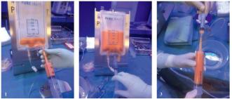 Abb. 2. Vorbereitung des Fettes in einem geschlossenen System (1). Das entnommene Fett wird in einen Plastikbehälter gefüllt, welcher die äussere Kammer inwendig durch ein Sieb trennt. Reinigen des Fettes durch Hinzugeben von Kochsalz-lösung, welches nach der Sedimentationsphase durch einen angehängten weiteren Plastikbehälter entsprechend der Schwerkraft zusammen mit den ungefilterten Partikeln abgelassen werden kann (2). Das gereinigte, sedimentierte Fett kann über den gleichen Zugang wieder entnommen und in kleinen Spritzen zur einfacheren Verteilung im Gewebe abgefüllt werden (3).