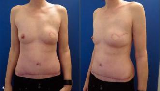 Abb. 3A. 44-jährige Patientin mit einem Mamma-Carzinom links. Hier Zustand nach Skin-Sparing-Mastektomie und mikro-vaskulärer DIEP-Lappenplastik. Postoperativ defizitärer Oberpol im Bereich des axillären Ausläufers, welcher mit dem auto-logen Gewebe nicht gefüllt werden konnte.