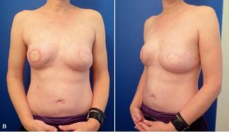 Abb. 3B. 6 Monate nach Lipofilling im Bereich des linken Oberpols. Zwischenzeitlich auch Mastektomie der Gegenseite bei nachgewiesener BRCA-Genmutation und Aufbau mit mikrovaskulärer Gesässlappenplastik.