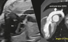 Sonoquiz Auflösung: Absent pulmonary valve Syndrom (APVS)