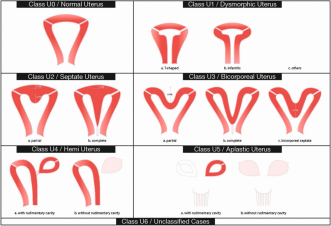 Abb. 1. ESHRE/ESGE-Klassifikation der Uterusanomalien: schematische Darstellung (Klasse U2: innere Einbuchtung >50 % der Uteruswanddicke & Außenkontur gerade oder mit Einkerbung <50 %; Klasse U3: äußere Einkerbung >50 % der Uterus-wandstärke; Klasse U3b: Breite der Grundvertiefung an der Mittellinie >150 % der Uteruswandstärke) [Hum. Reprod., 2013, 28: 2032–2044].
