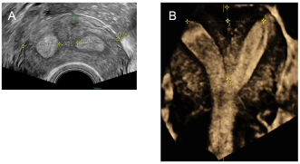 Abb. 3. Uterine Malformation ESHRE/ESGE U2b; A: 2-D-Transvaginalsonographie; B: 3-D-Transvaginalsonographie (Bild: L. Raio).