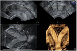 Abb. 4. Uterine Malformation ESHRE/ESGE U2b; Multiplanare Darstellung (Bild: L. Raio).