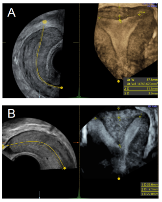 Abb. 5. A: Normaler Uterus U0; B: Uterine Malformation ESHRE/ESGE U2b. Die Länge des zu resezierenden Anteils des Septum uteri kann dank dem 3-D-Bild präoperativ bemessen werden (hier 3 = 22 mm) (Bild: L. Raio).