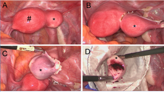 Abb. 6. Exzision eines rudimentären nicht kommunizierenden rudimentären Uterushorn rechts (ESHRE/ESGE U4a); A: Un-auffälliger Hemi-Uterus links (#), nicht kommunizierendes rudimentäres Uterushorn rechts (*); B: Exzision des nicht kommu-nizierenden Uterushorn rechts (*) an der Grenze zum gesunden linken Hemi-Uterus (X); C: Abgesetztes rudimentäres Ute-rushorn rechts (*) und Naht mit V-Lock 2-0 (~); D: Entfernen des abgesetzten Uterushorns rechts (*) in einem Bergesack.
