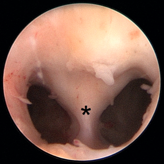 Abb. 7. Hysteroskopische Sicht eines Uterus subseptus (ESHRE/ESGE U2a) (* = Septum uteri).