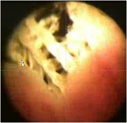 Abb. 2. Zystoskopisches Bild von alloplastischem intravesikalem Material