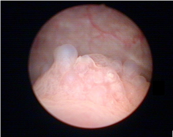 Abb. 3. Zystoskopie: Entzündliche Veränderungen mit angedeuteter Zystitis Zystica