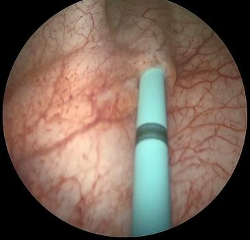 Abb. 1. Retrograde Füllung des Ureters über einen Ureter­katheter (Charrière 6 – 4 cm in den Ureter eingeführt).  