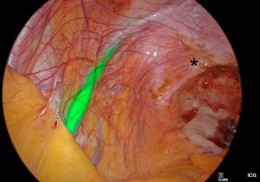 Abb. 2. Linker Ureter (grün) nach retrograder Injektion von 5 ml ICG-Lösung bei einer Patientin mit tiefinfiltrierender Endo-metriose (* Beginn des Knotens).