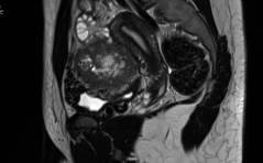 Der spezielle Fall: Perivaskulärer epitheloid­zelliger Tumor (PECom)