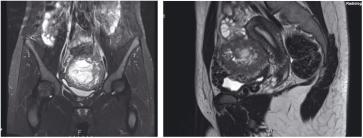 Abb. 1. Präoperatives MRI