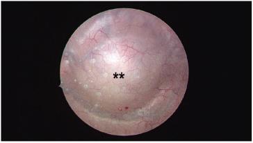 Abb. 4. Zystoskopie mit Impression des Blasendaches