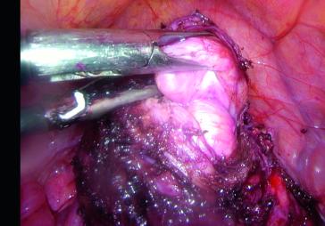 Intraoperativer Situs zu Beginn der Operation