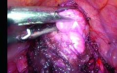 Im Bild - Endometriose einmal anders