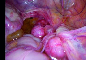 Infiltration der muskulären Darmwand durch knotige Endometriose