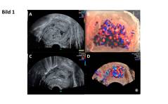 Im Bild: Uterine arterio-venöse Malformationen: eine Fallserie aus Bern