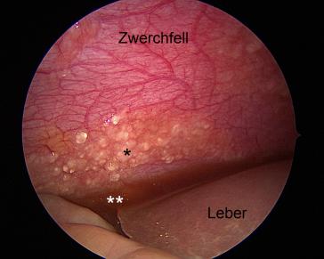 Abb. 1. Zwerchfellkuppe rechts: Muzinöses Implant (*); muzinöser Aszites (**)