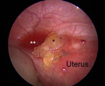 Abb. 2. Sicht ins kleine Becken: Muzinöses Implant (*); muzinöser Aszites (**)