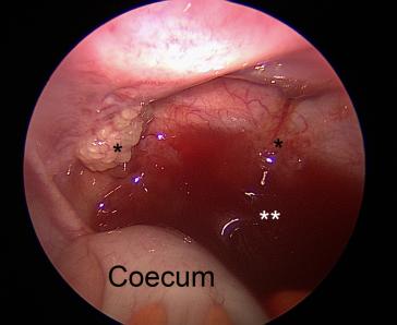 Abb. 3. Sicht auf die rechte Flanke: Muzinöse Implants (*); muzinöser Aszites (**)
