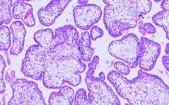 Auflösung Sonoquiz: Das Mirror-Syndrom