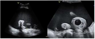 Beispiel 1: Hier liegt ein sog. poliurisches Polyhydramnion vor.  Das Kind wies ständig eine „Megazystis“ auf und das Fruchtwasser hat progressive zugenommen. Postnatal wurde beim Kind eine hereditäre, renale Tubulusschädigung nachgewiesen. 