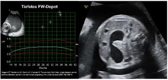 Beispiel 2: Hier liegt das klassische Bild einer Duodenalstenose vor mit „double bubble“ und progressivem Polyhydramnion.