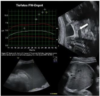 Beispiel 3: Massives, progressives Polyhydramnion. Magen nicht sicher darstellbar und im Halsbereich Pouch-Bildung bei einer Oesophagusatresie, wobei sich hier der Pouch retrograde via Fistel gefüllt hat.
