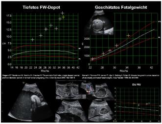 Beispiel 4: Progressives Polyhydramnion und Makrosomie bedingt durch Hepatomegalie bei fetaler Anämie infolge Hyper-zirkulation. In der Plazenta sieht man multiple, echoleere Tumoren, welche Chorangiomen entsprechen.