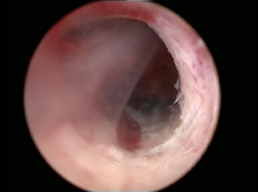 Abb. 1. Intrauterine Adhäsion