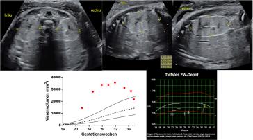 Nierendysplasie, Bardet-Biedl-Syndrom