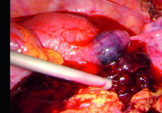 Intraoperativer Situs zu Beginn 