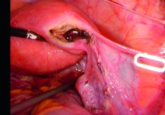 Intraoperativer Situs nach Salpingektomie 